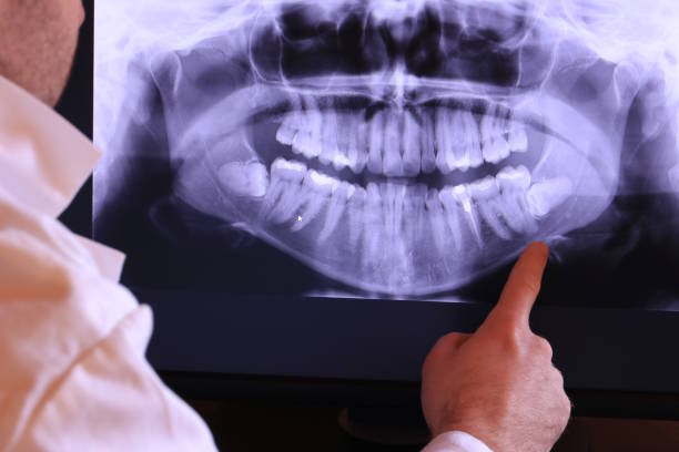 Best Emergency Dental Care for Broken or Chipped Teeth in Saint John Fisher College, NY