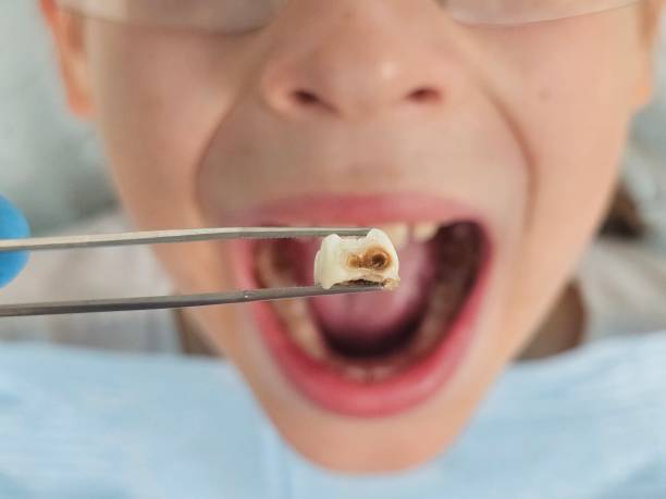 Best Emergency Dental Care for Broken or Chipped Teeth in Saint John Fisher College, NY